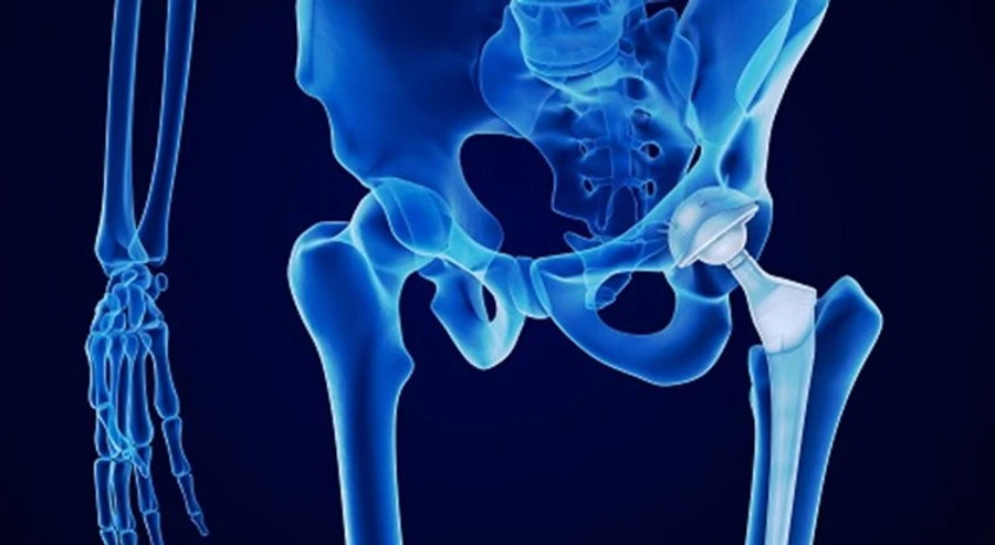 Preparing for Hip and Knee Surgery